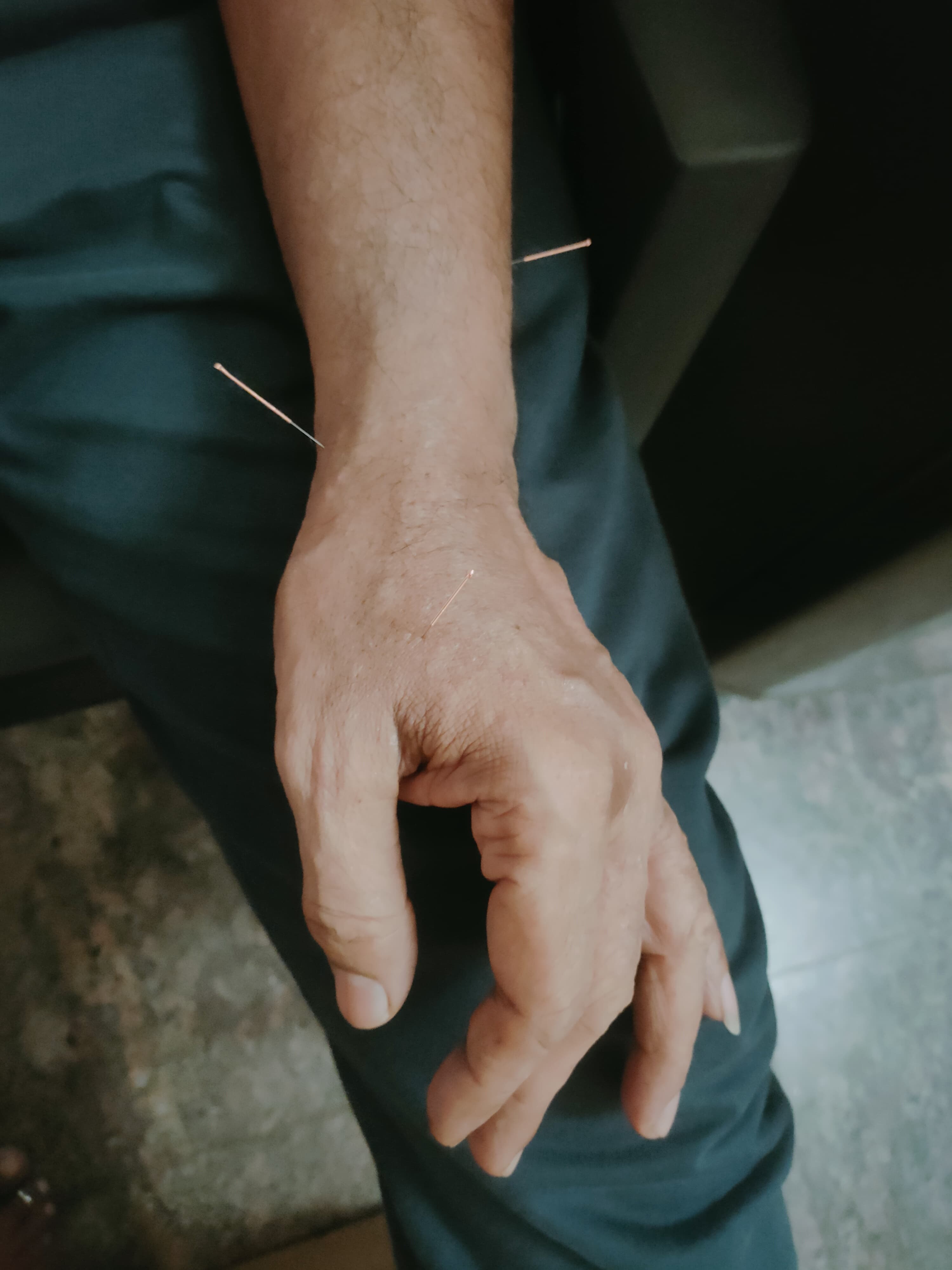 Acupuncture Therapy